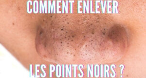 Comment enlever les points noirs ?