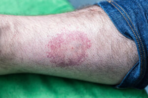 blessure Lyme