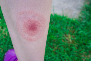 blessure Lyme 
