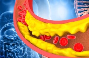 Une artère bouchée à cause du cholesterol