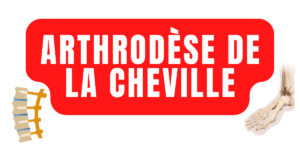 arthrodèse de la cheville
