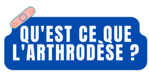arthrodese