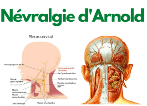 Névralgie d'Arnold
